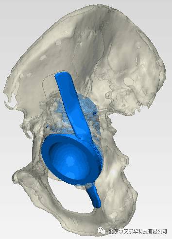 3D打印在髋关节领域的应用与创新最新进展